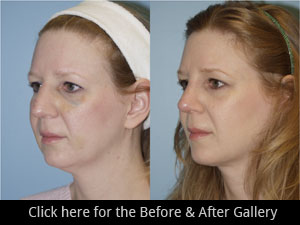 Rhinoplasty Chicago, IL | Nose Job Surgery