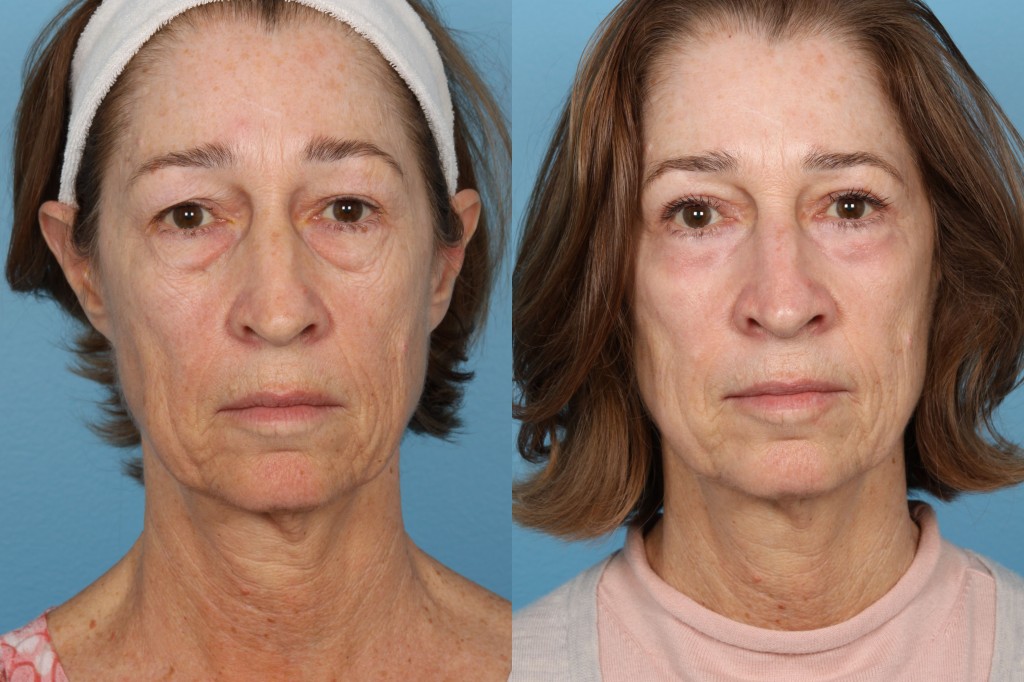 Blepharoplasty (Eyelid Surgery)