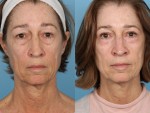 Blepharoplasty (Eyelid Surgery)