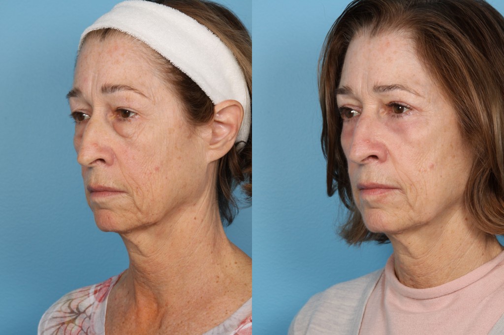 Blepharoplasty (Eyelid Surgery)