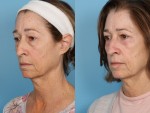 Blepharoplasty (Eyelid Surgery)