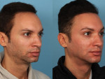 Hairline Reduction