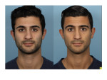 Male Rhinoplasty