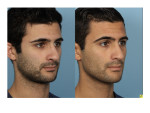 Male Rhinoplasty