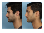 Male Rhinoplasty