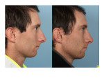 Male Rhinoplasty