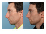 Male Rhinoplasty