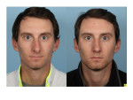 Male Rhinoplasty