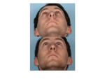 Male Rhinoplasty