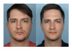 Male Rhinoplasty