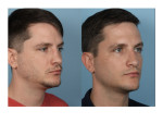 Male Rhinoplasty