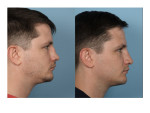 Male Rhinoplasty