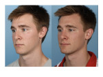 Male Rhinoplasty