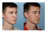 Male Rhinoplasty