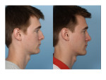 Male Rhinoplasty