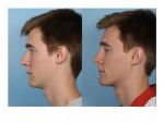 Male Rhinoplasty