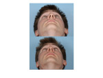 Male Rhinoplasty