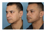 Male Rhinoplasty