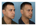 Male Rhinoplasty