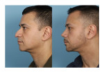 Male Rhinoplasty