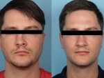 male_rhinoplasty