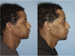 Male Rhinoplasty