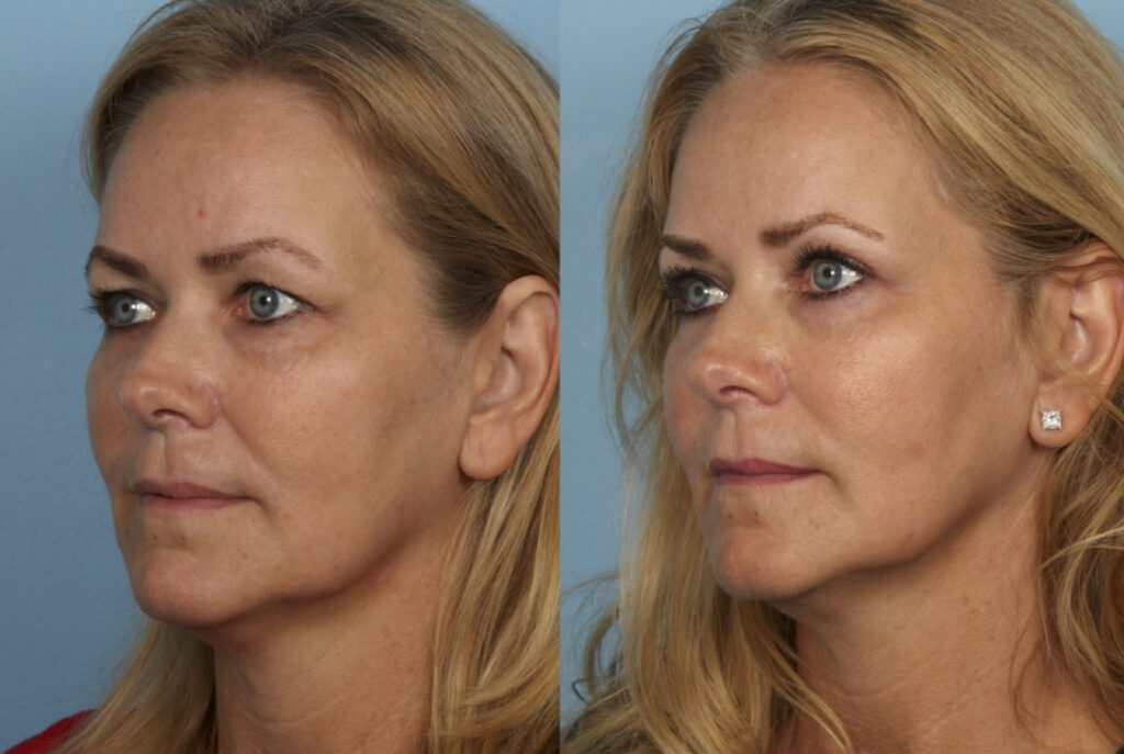 Blepharoplasty (Eyelid Surgery)