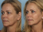 Blepharoplasty (Eyelid Surgery)