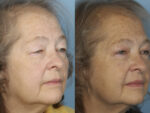 Blepharoplasty (Eyelid Surgery)