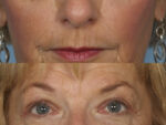 Blepharoplasty (Eyelid Surgery)