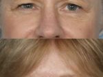 Blepharoplasty (Eyelid Surgery)