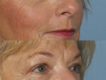 Blepharoplasty (Eyelid Surgery)