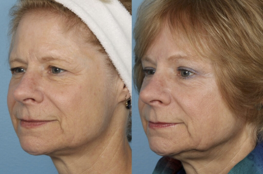 Blepharoplasty (Eyelid Surgery)