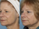 Blepharoplasty (Eyelid Surgery)