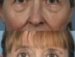 Blepharoplasty (Eyelid Surgery)