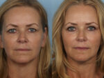 Blepharoplasty (Eyelid Surgery)