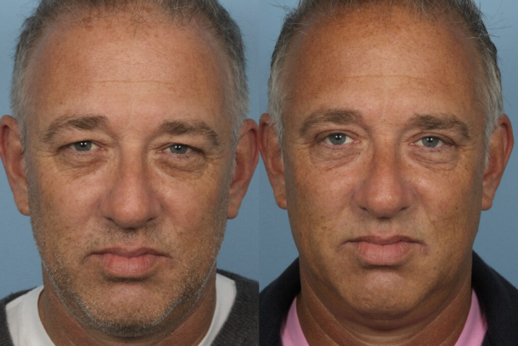 Blepharoplasty (Eyelid Surgery)