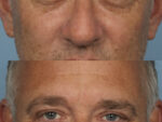 Blepharoplasty (Eyelid Surgery)