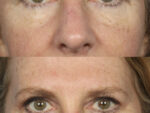 Blepharoplasty (Eyelid Surgery)