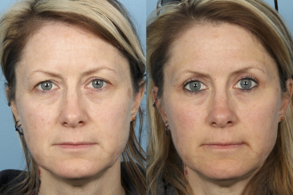 Blepharoplasty (Eyelid Surgery)