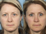 Blepharoplasty (Eyelid Surgery)