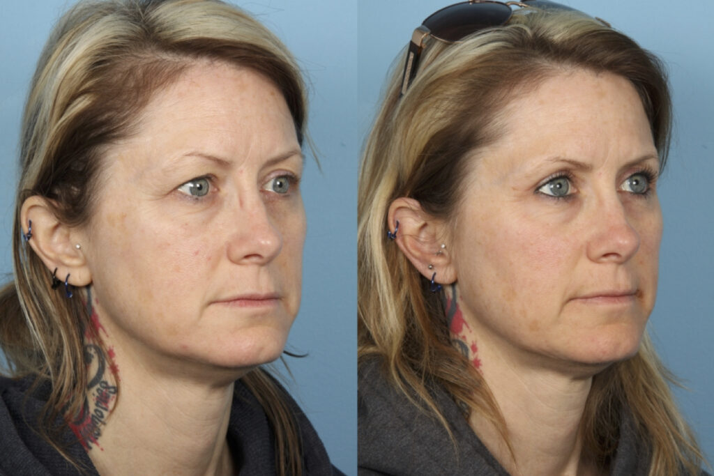 Blepharoplasty (Eyelid Surgery)