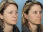 Blepharoplasty (Eyelid Surgery)