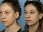 Blepharoplasty (Eyelid Surgery)