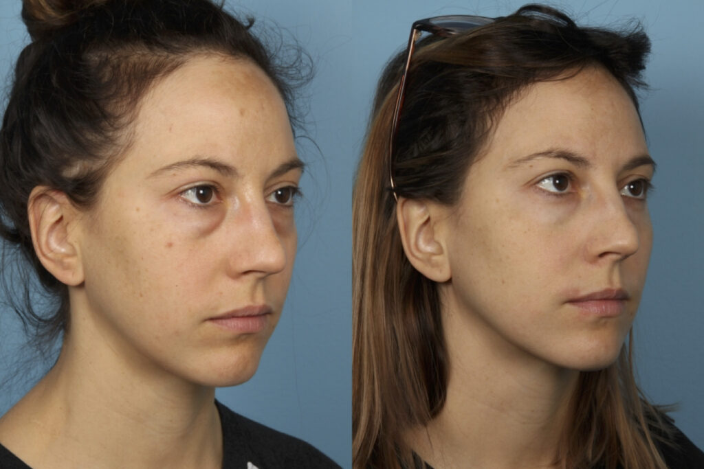 Blepharoplasty (Eyelid Surgery)