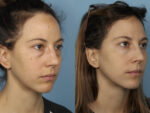 Blepharoplasty (Eyelid Surgery)