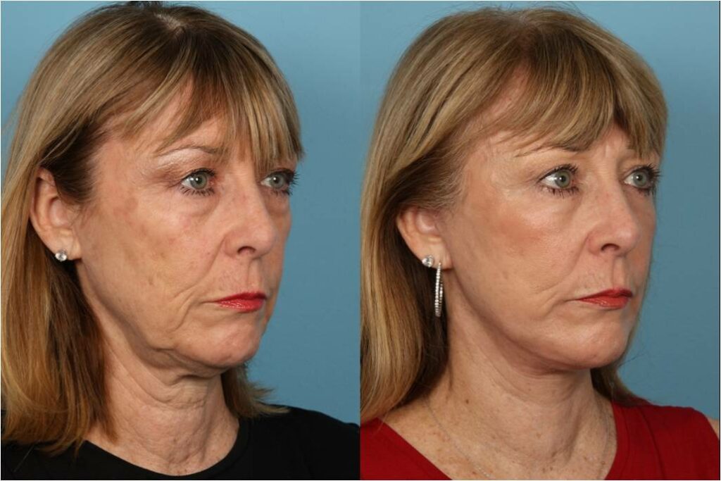 Facelift and Necklift