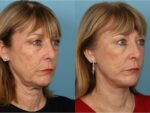 Facelift and Necklift