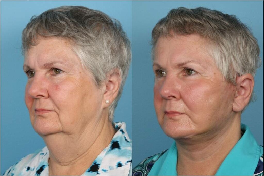 Facelift and Necklift