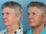 Facelift and Necklift